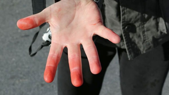 Uşaqlarda COVID-19-un təhlükəli simptomu açıqlandı -FOTO