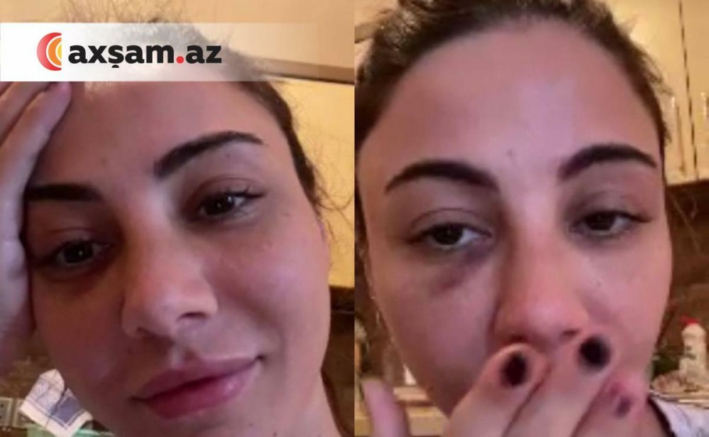 Azərbaycanlı müğənni qəza törətdi, üzü tanınmazhala düşdü - FOTOLAR