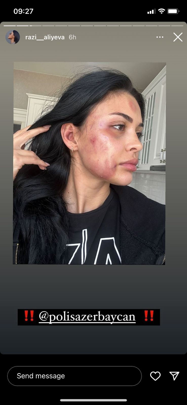 Razini döyənZiya Hüseynzadə cəzalandırıldı