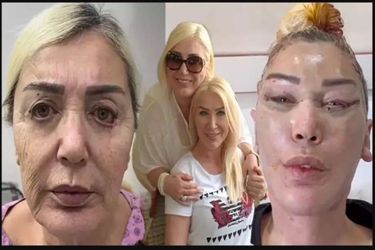 Məşhur müğənninin bacısı tanınmaz halda- Plastik əməliyyat etdirib görün nə hala düşdü