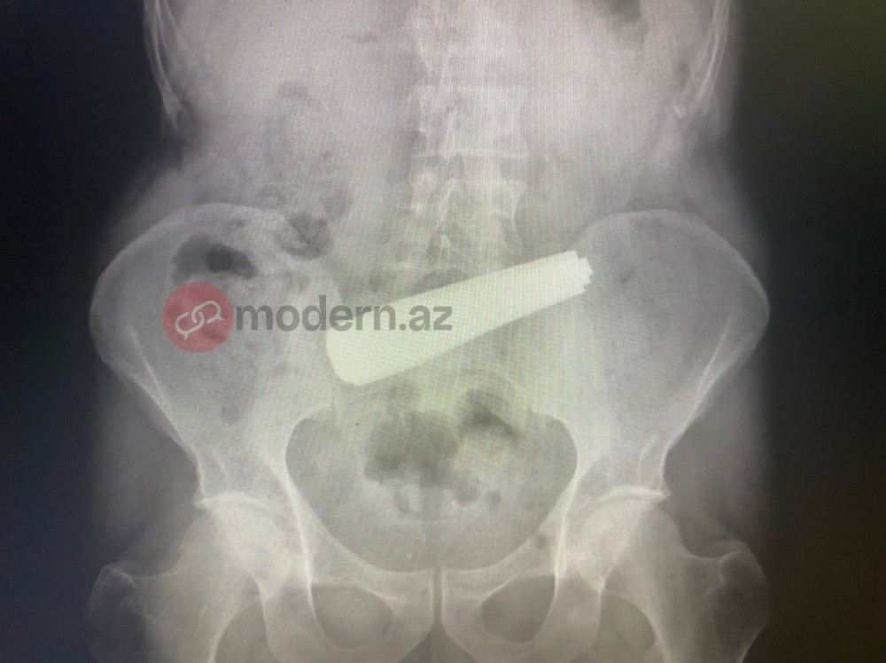 Bakı sakini 9 ədəd qaşıq uddu - FOTOLAR