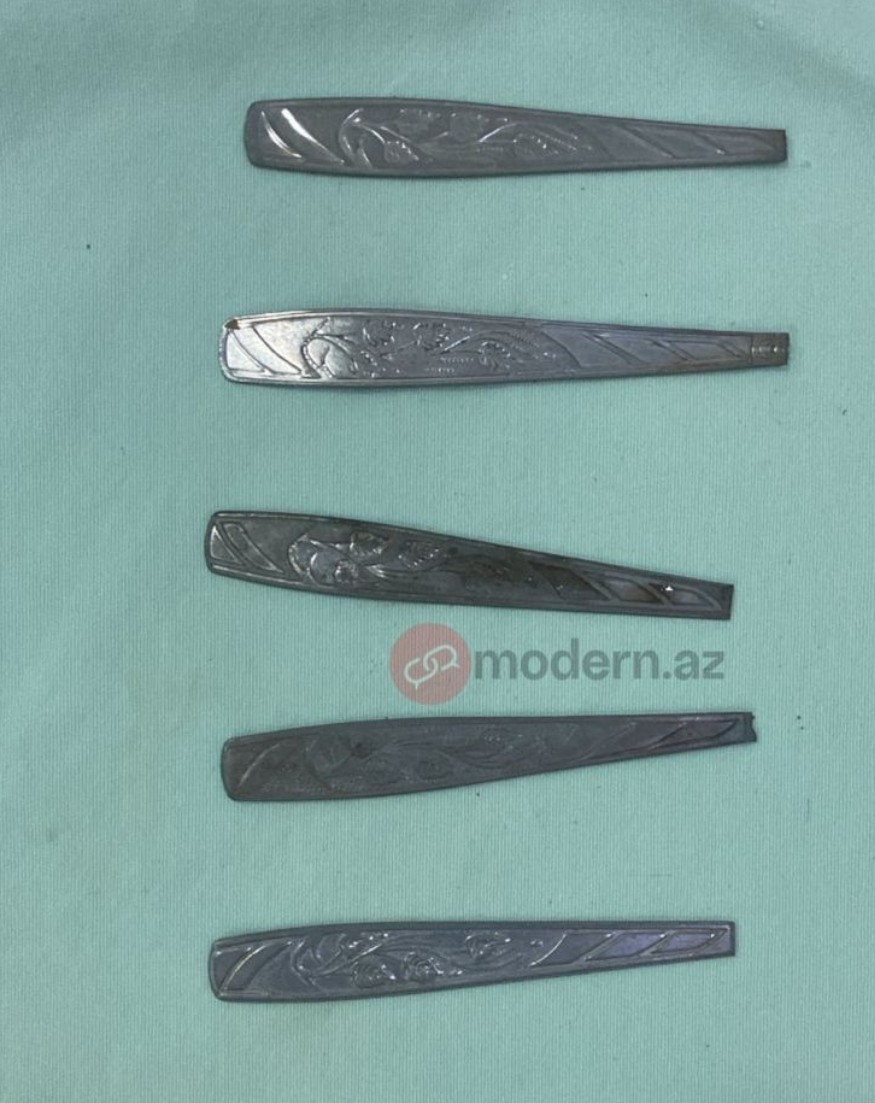 Bakı sakini 9 ədəd qaşıq uddu - FOTOLAR